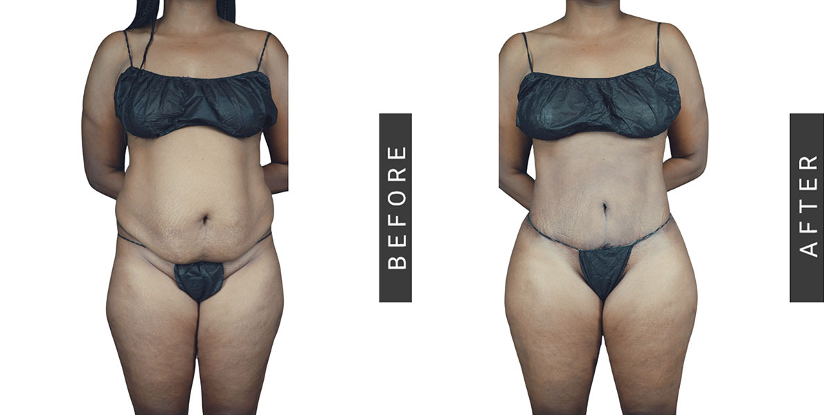 BBL with Tummy Tuck and Lipo360 Before and After