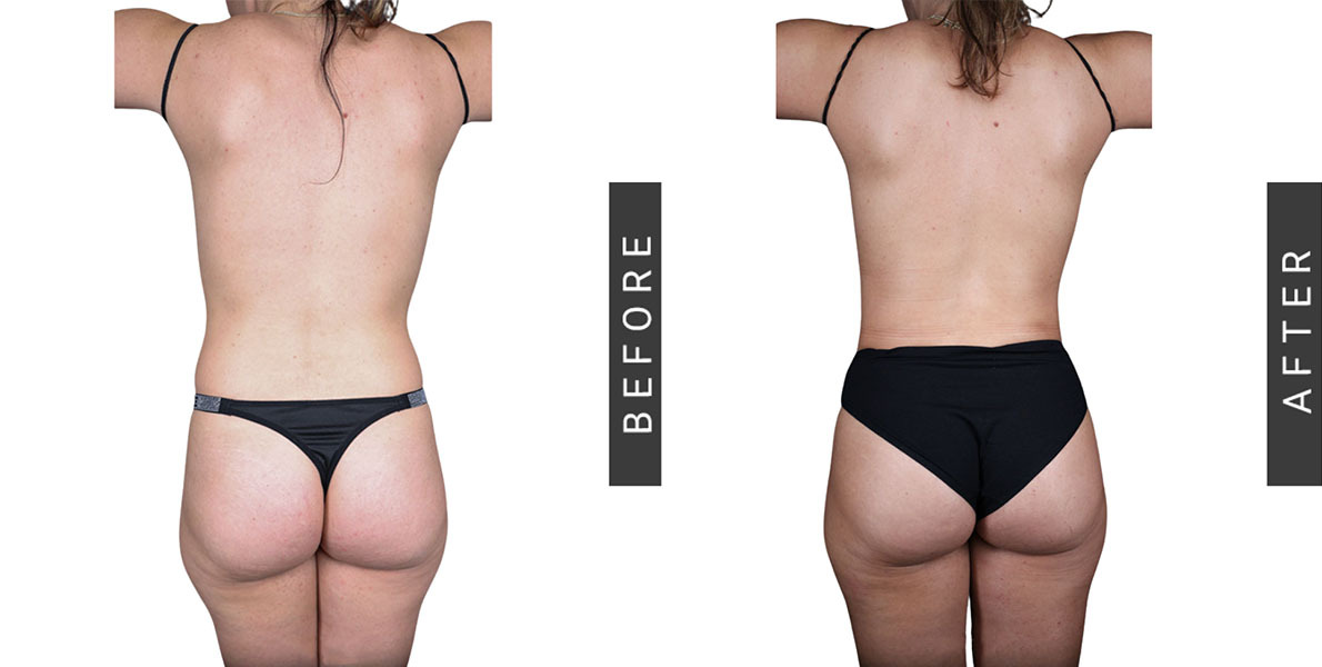 Liposuction Before and After