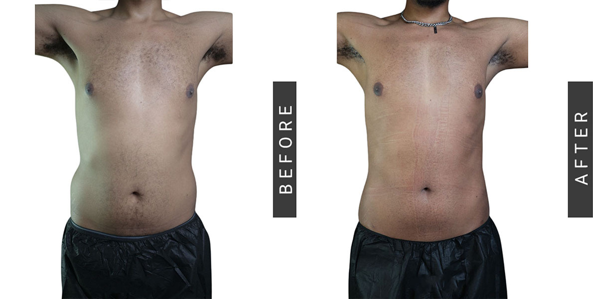 Liposuction Before and After