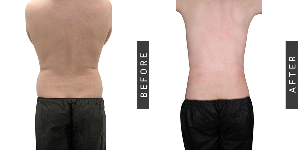 Liposuction Before and After