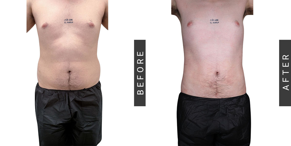Liposuction Before and After