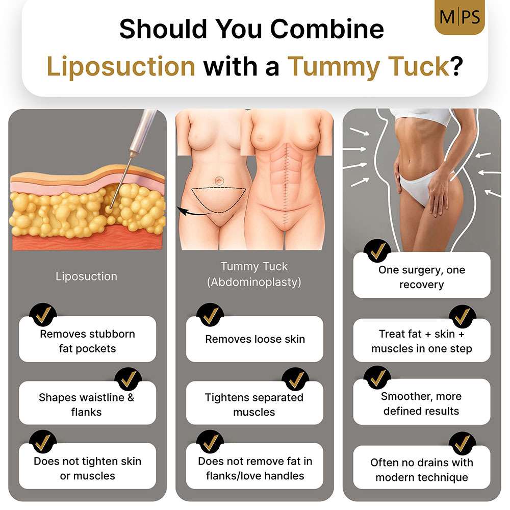 Should You Combine Liposuction with a Tummy Tuck, NYC