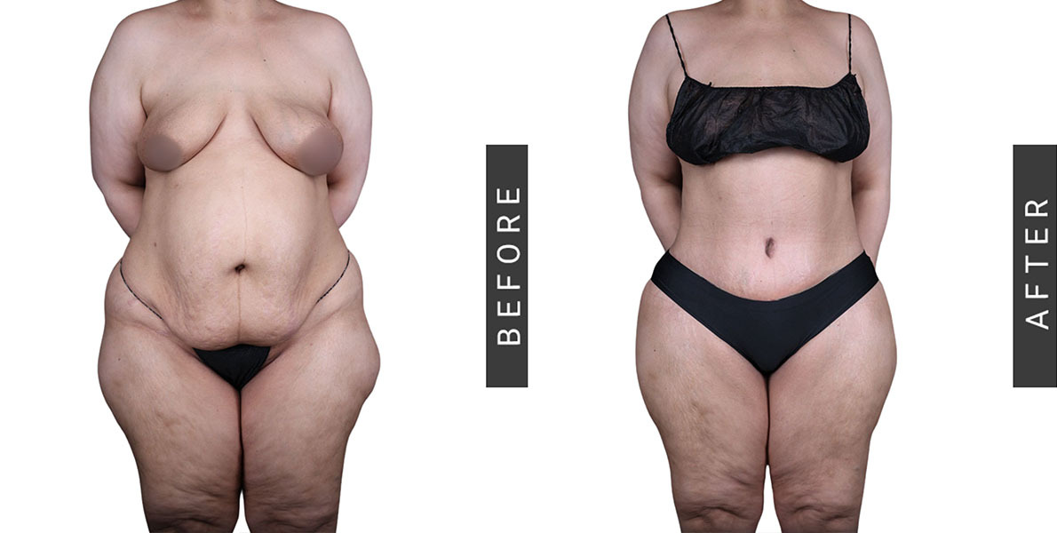 Tummy Tuck Before and After
