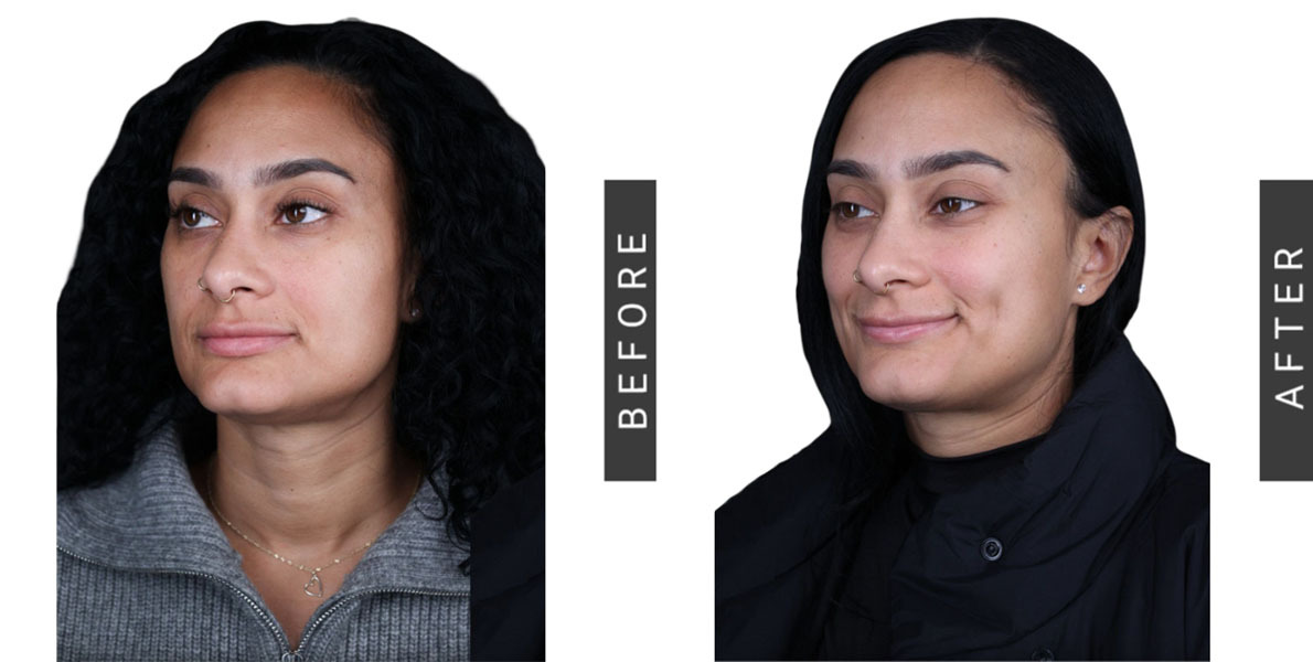 Dimpleplasty Before and After