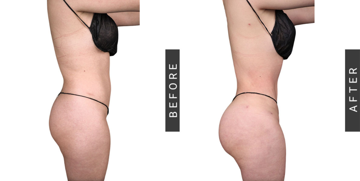 BBL Before and After