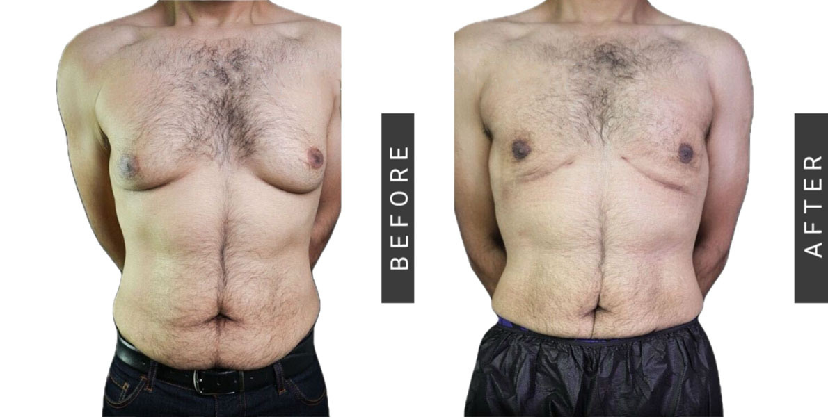 Gynecomastia Before & After