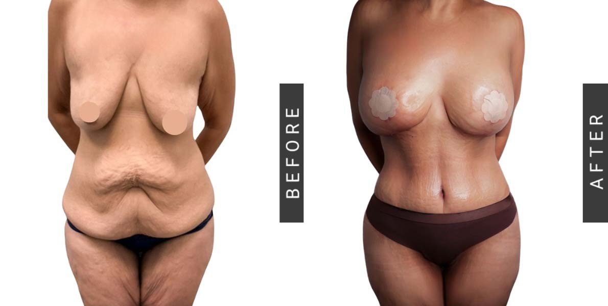 Mommy Makeover Before and After