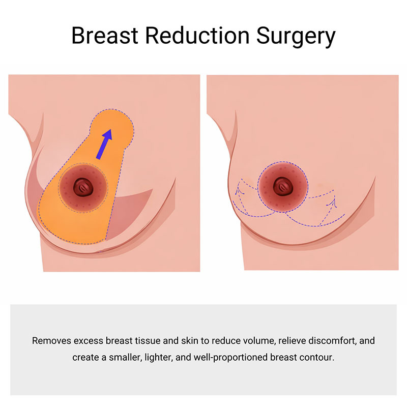 Breast Reduction Surgery