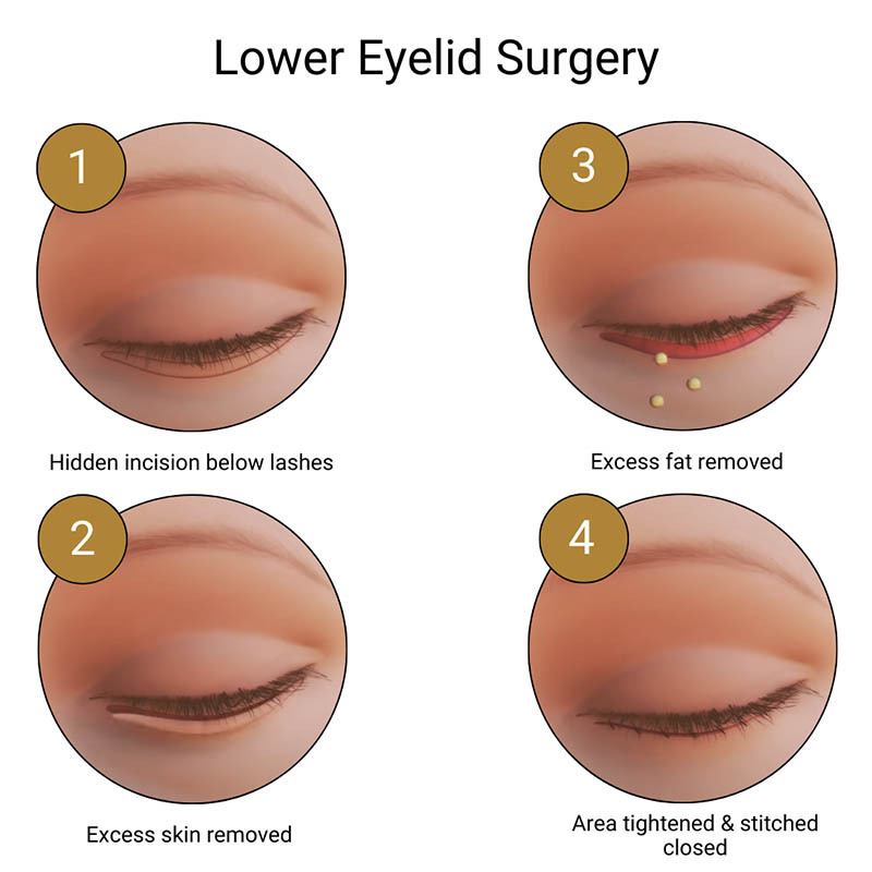 Lower Eyelid Surgery