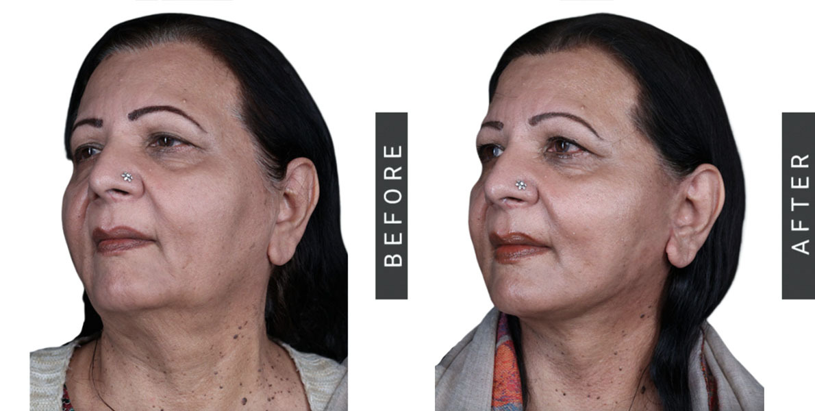 Facelift and Necklift Before & After