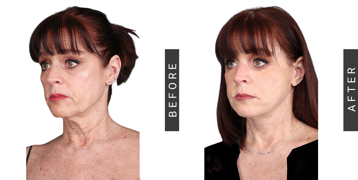 Necklift Before & After
