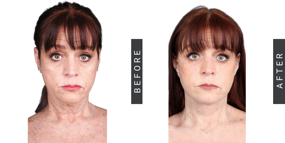 Necklift Before & After