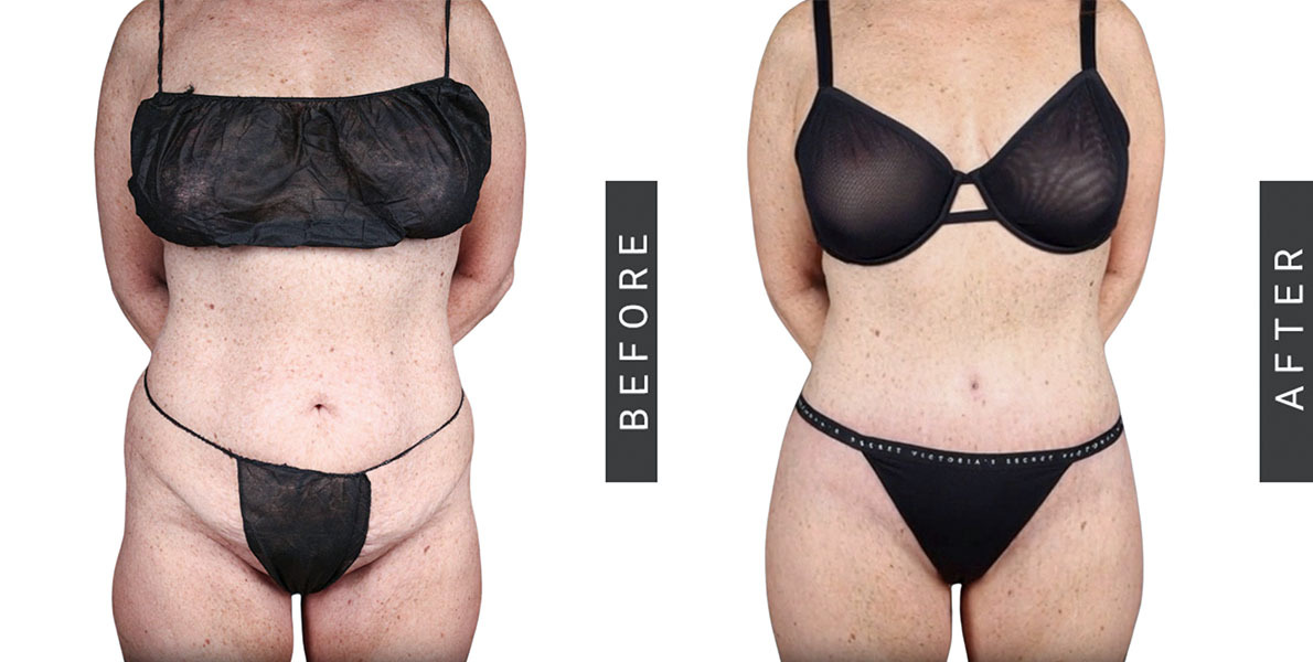 Tummy Tuck Before and After