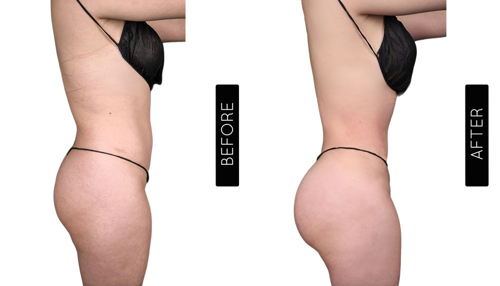 BBL Before and After