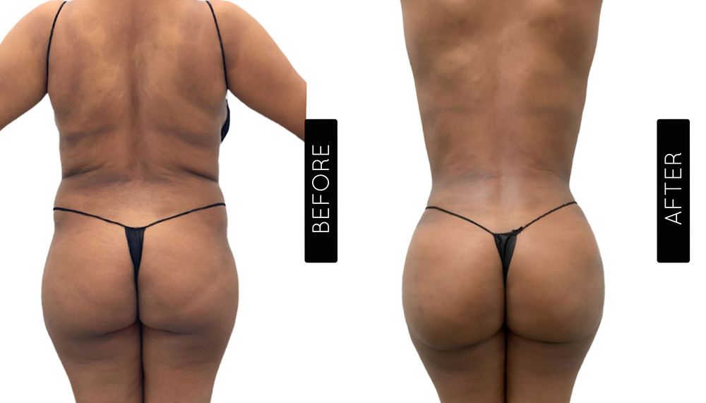 BBL Before and After