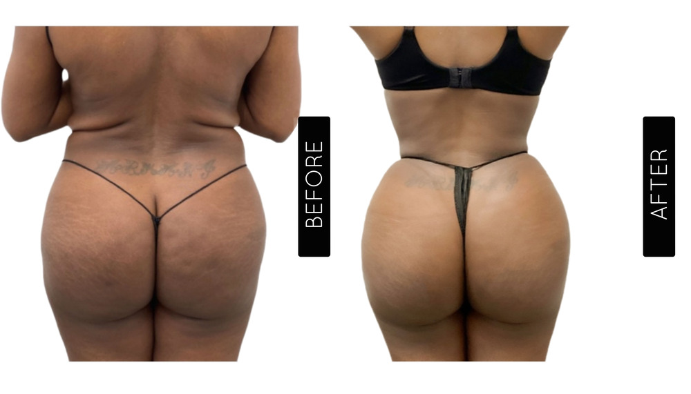 BBL Before and After