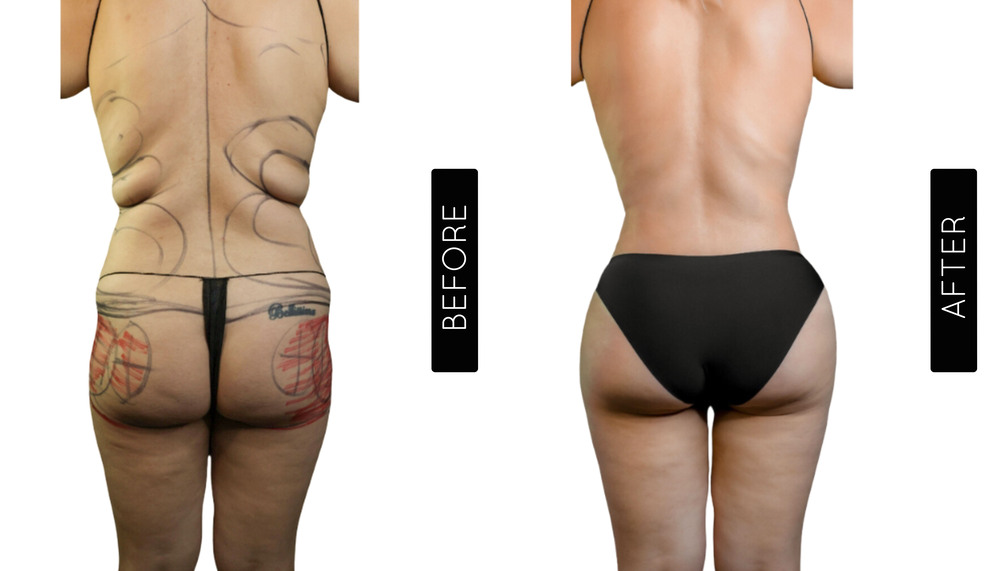 BBL Before and After