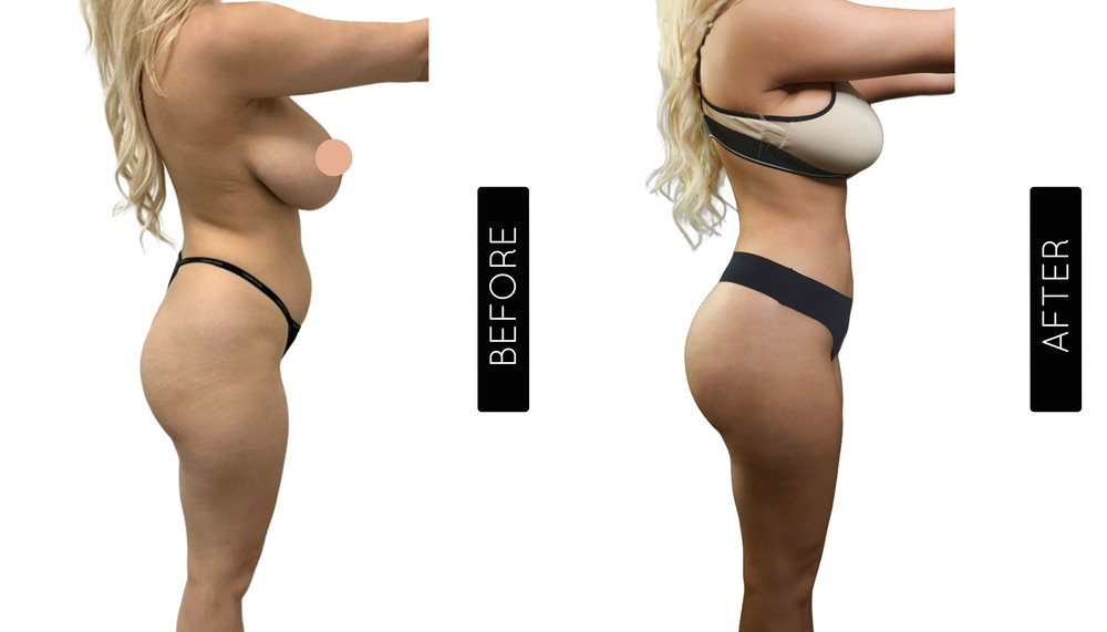 BBL Before and After