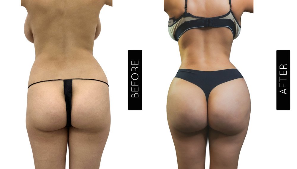 BBL Before and After