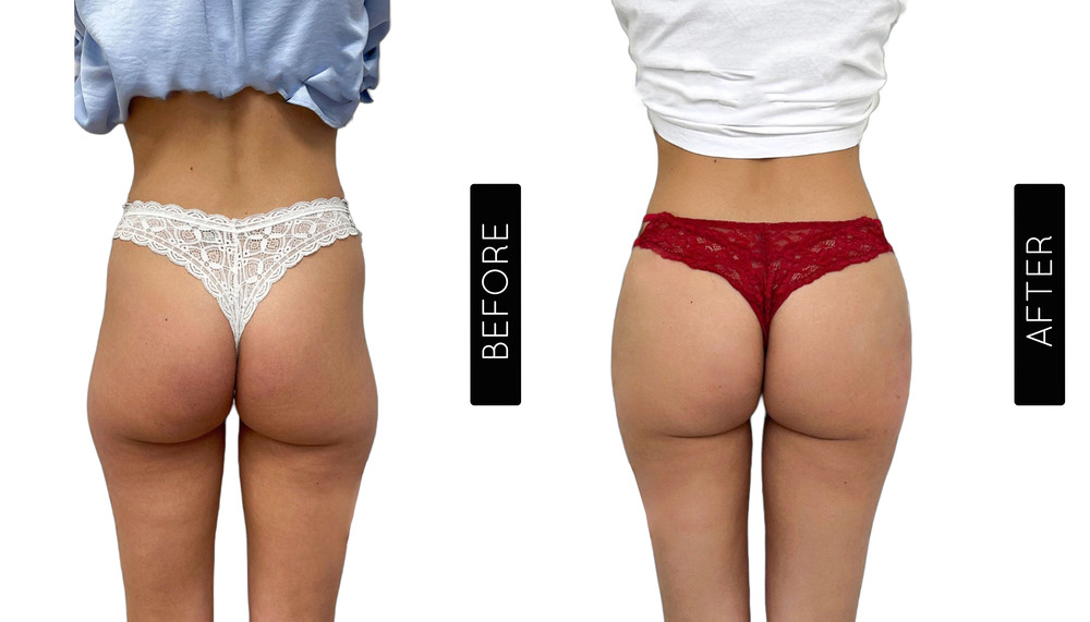 BBL Before and After