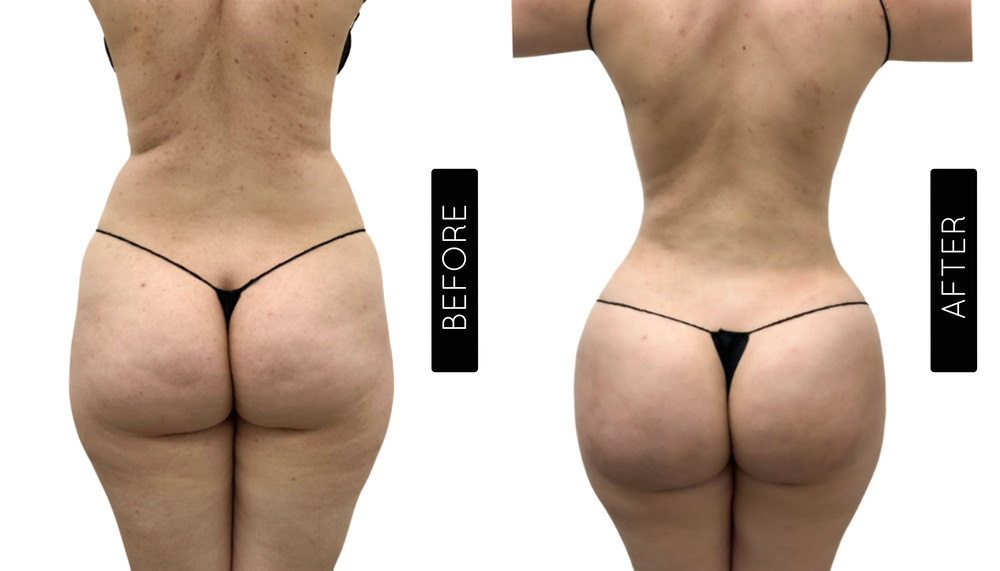 BBL Before and After