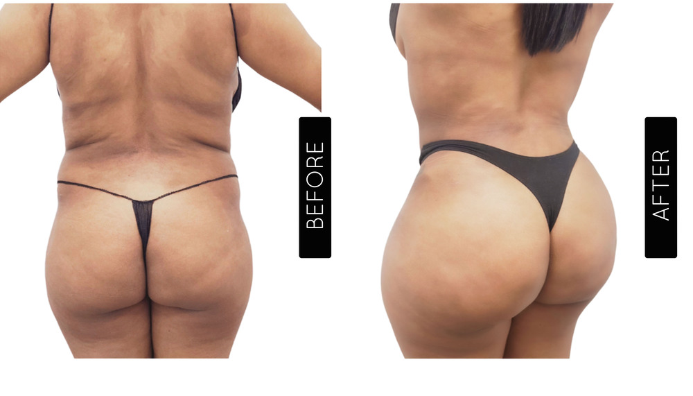 BBL Before and After