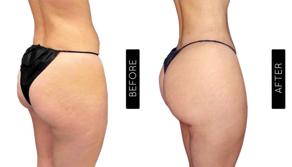 BBL Before and After