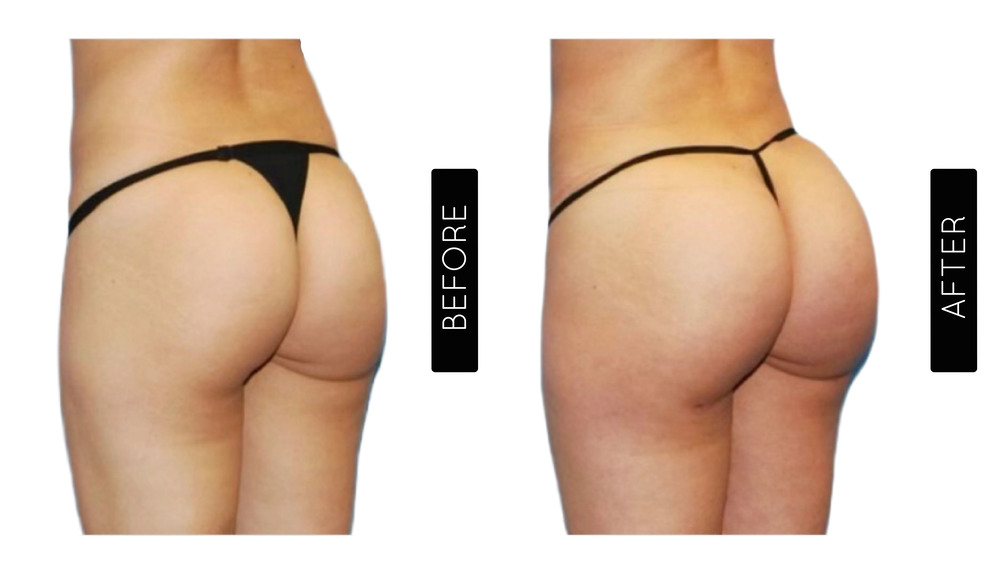 BBL Before and After