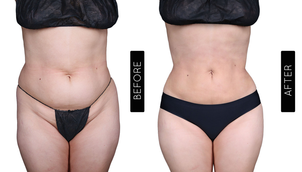 BBL Before and After