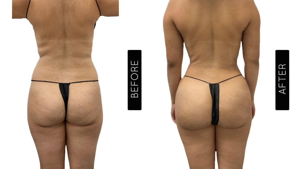 BBL Before and After