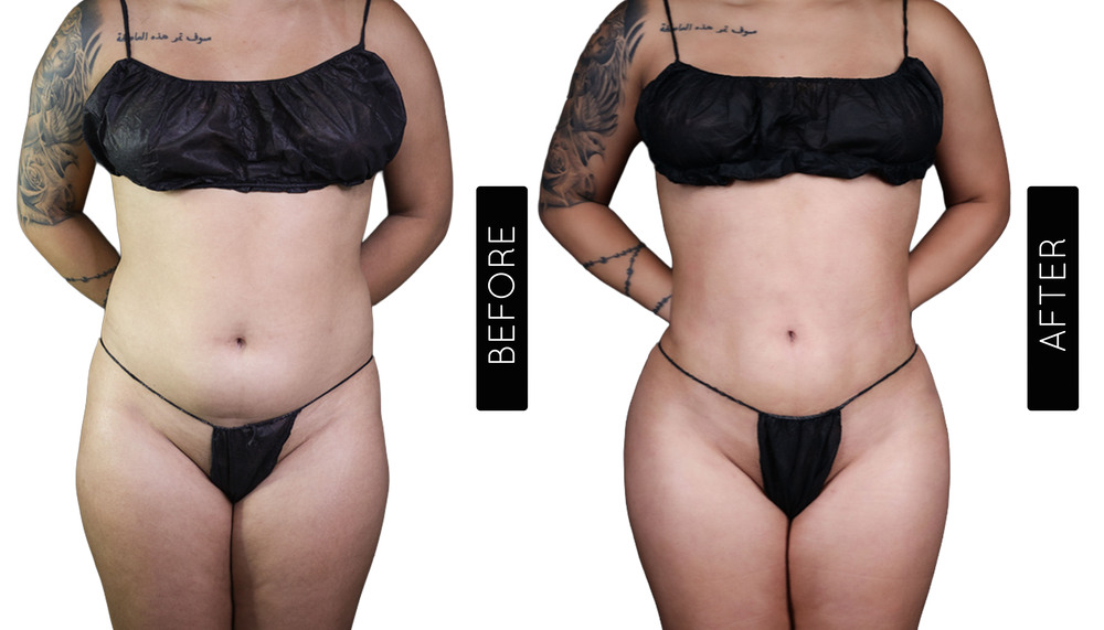 BBL Before and After