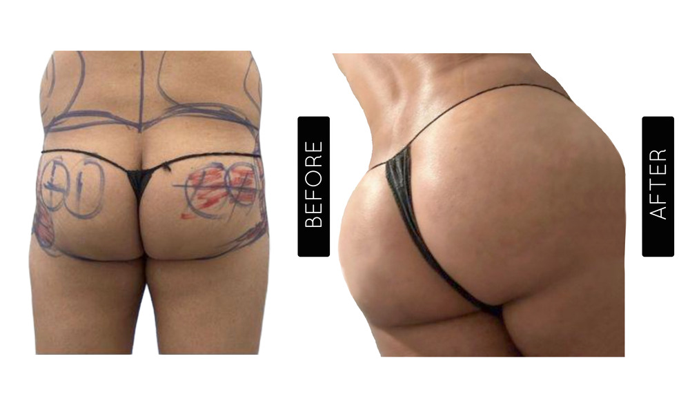 BBL Before and After