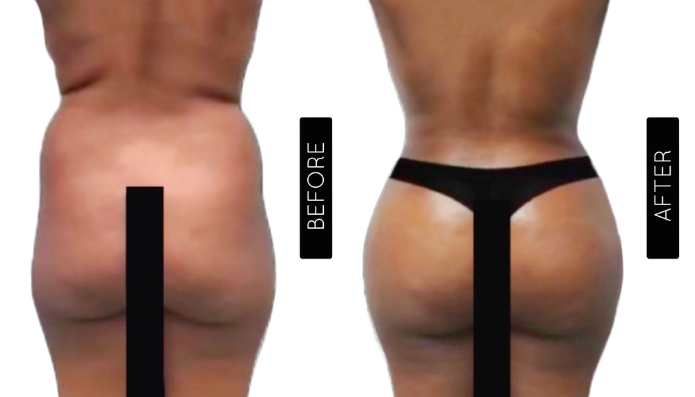 BBL Before and After