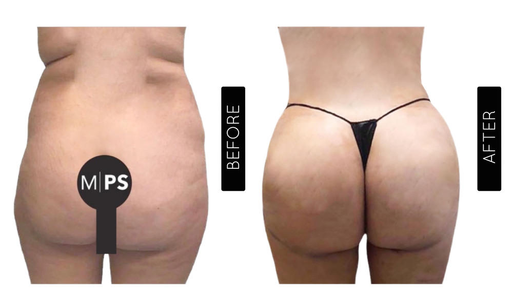 BBL Before and After