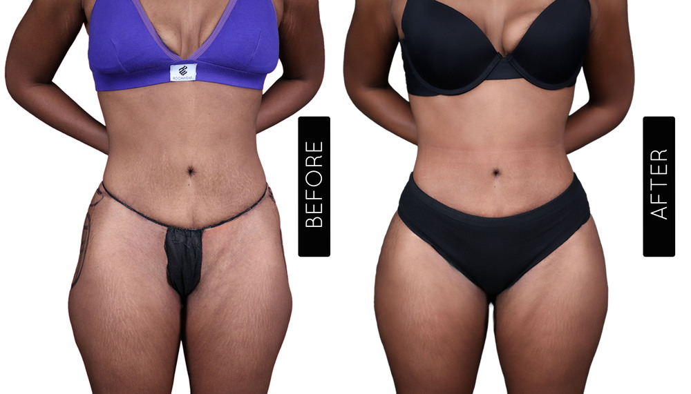 BBL Before and After