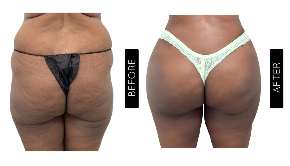 BBL Before and After