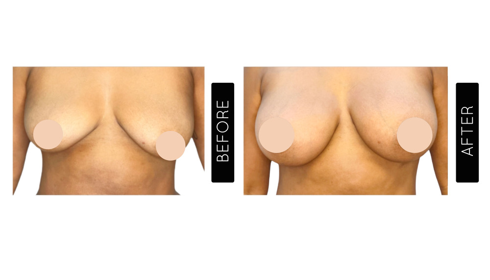 Breast Augmentation Before and After