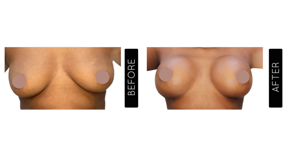 Breast Augmentation Before and After