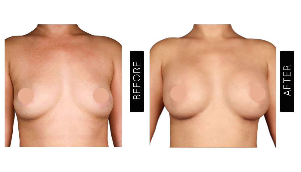 Breast Augmentation Before and After