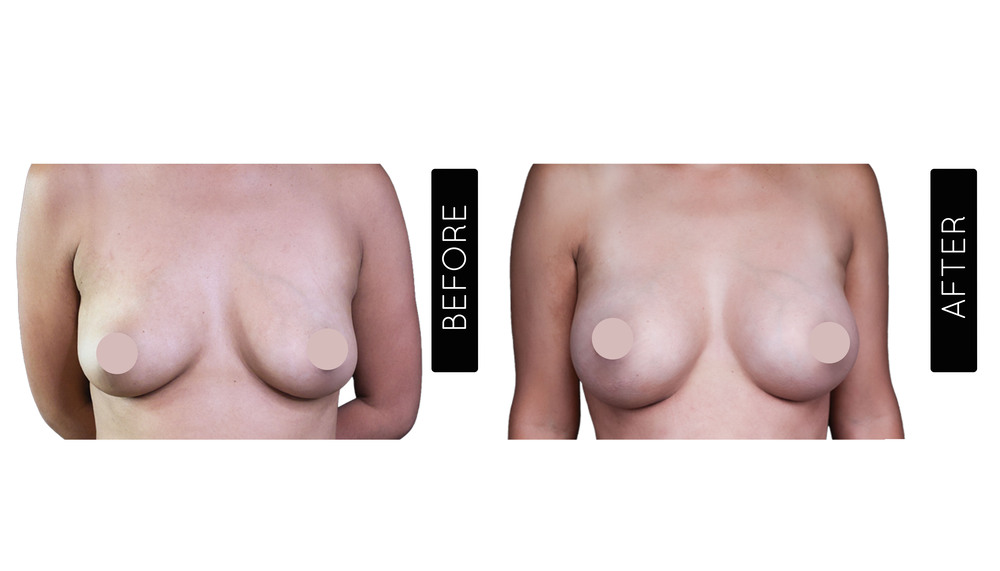 Breast Augmentation Before and After
