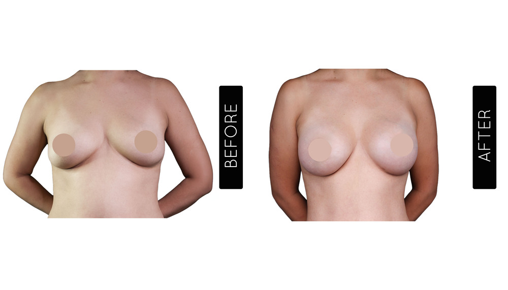 Breast Augmentation Before and After