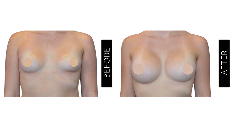 Breast Augmentation Before and After