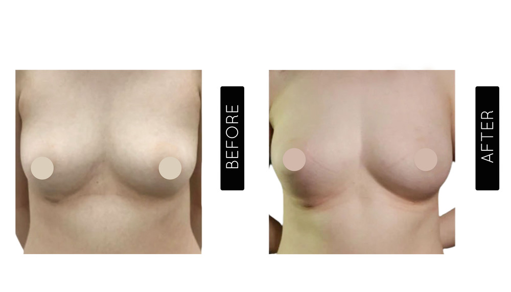 Breast Augmentation Before and After