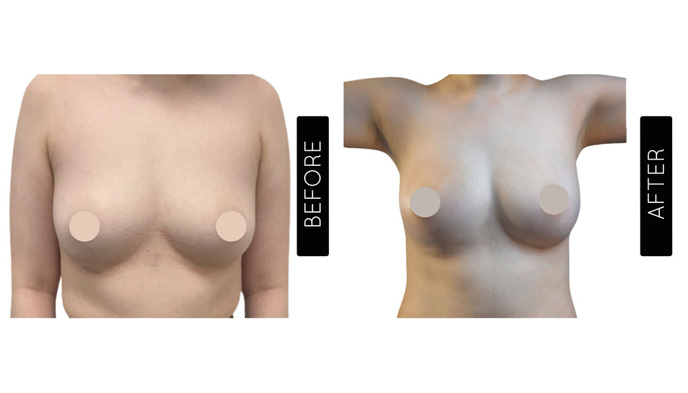 Breast Augmentation Before and After