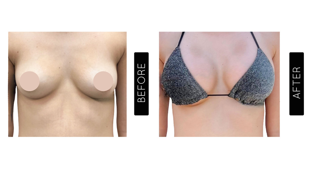 Breast Augmentation Before and After