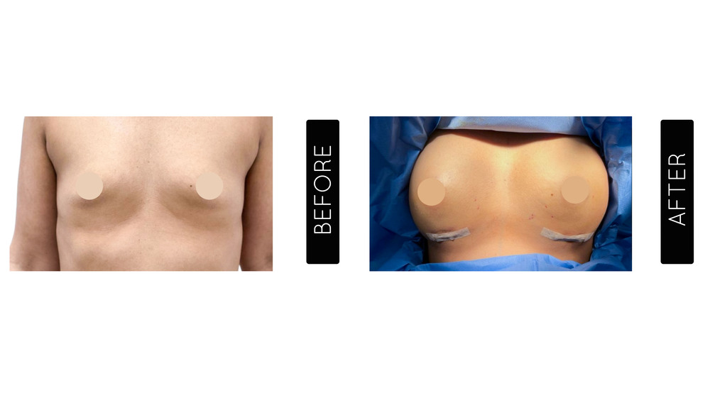 Breast Augmentation Before and After