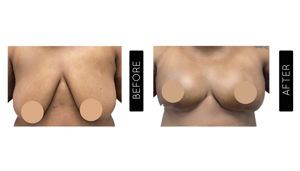 Breast Lift Before and After