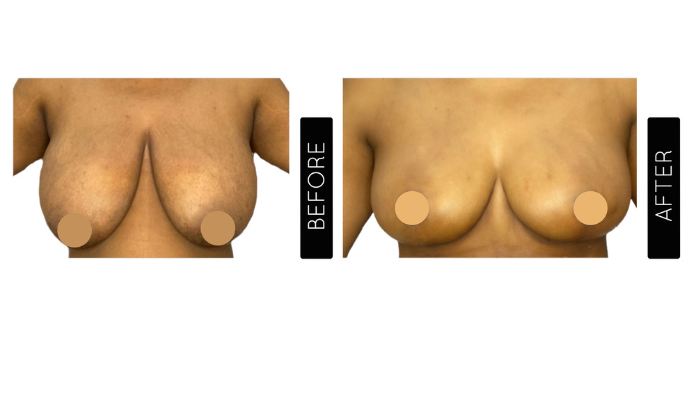 Breast Lift Before and After