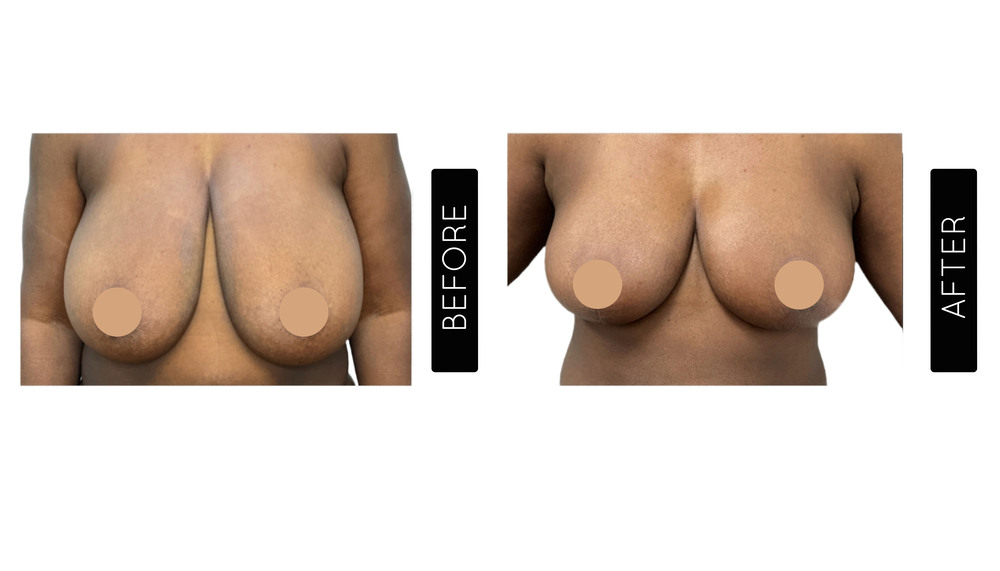 Breast Lift Before and After