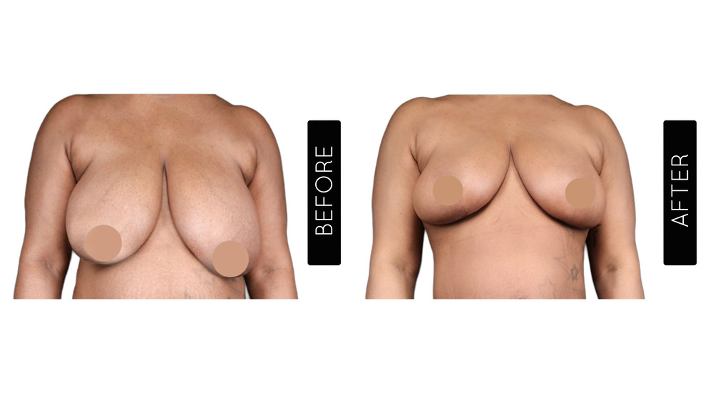 Breast Reduction Before and After